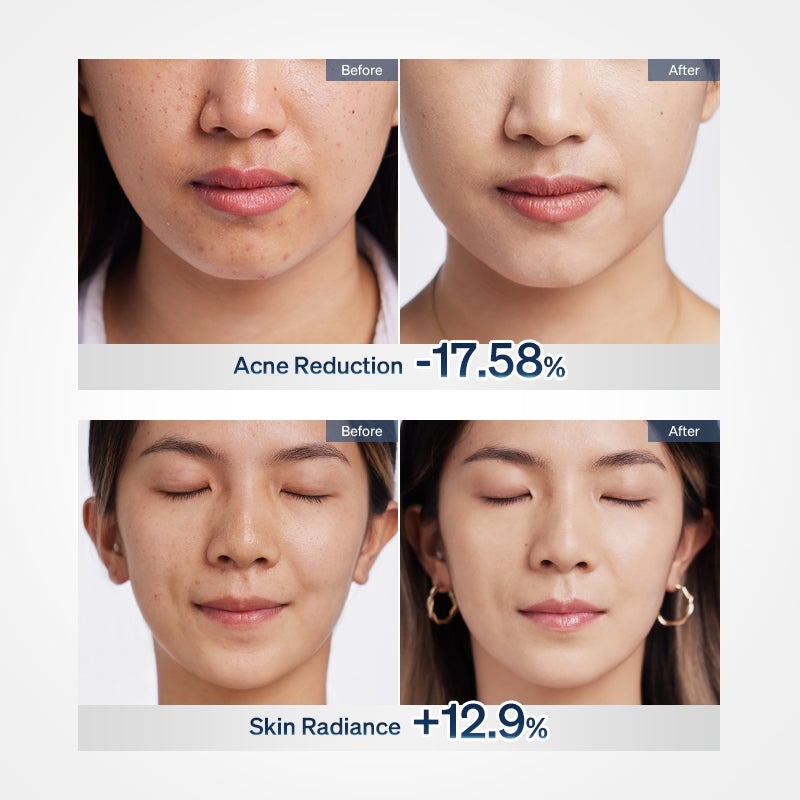 Ulike ReGlow LED Face Mask Glowing Results in 14 Days